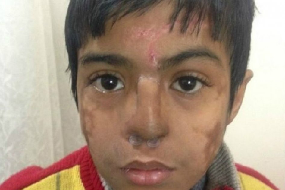 El niño al que le trasplantaron una nariz que creció en su frente