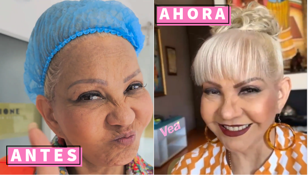 ‘La Gorda Fabiola’ se hizo procedimiento en los labios. Así quedó la humorista