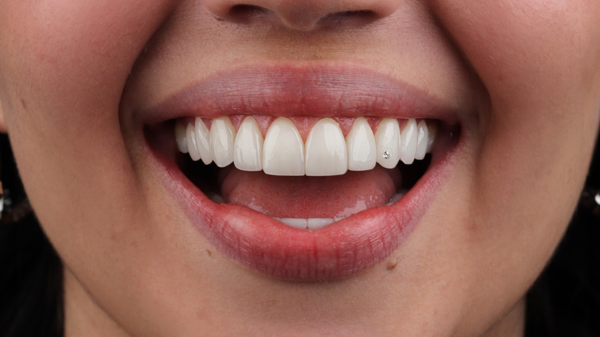 Los dientes gigantes no son la solución: ¿cómo lograr un diseño de sonrisa natural?