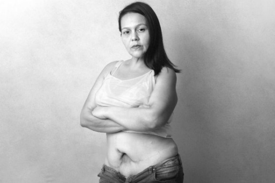 Diana Paola Cordero sufrió lesiones de por vida luego de haberse sometido a una liposucción y abdominoplastia con el falso cirujano plástico Ramiro Alberto Pestana en Montería. / Cristian Garavito