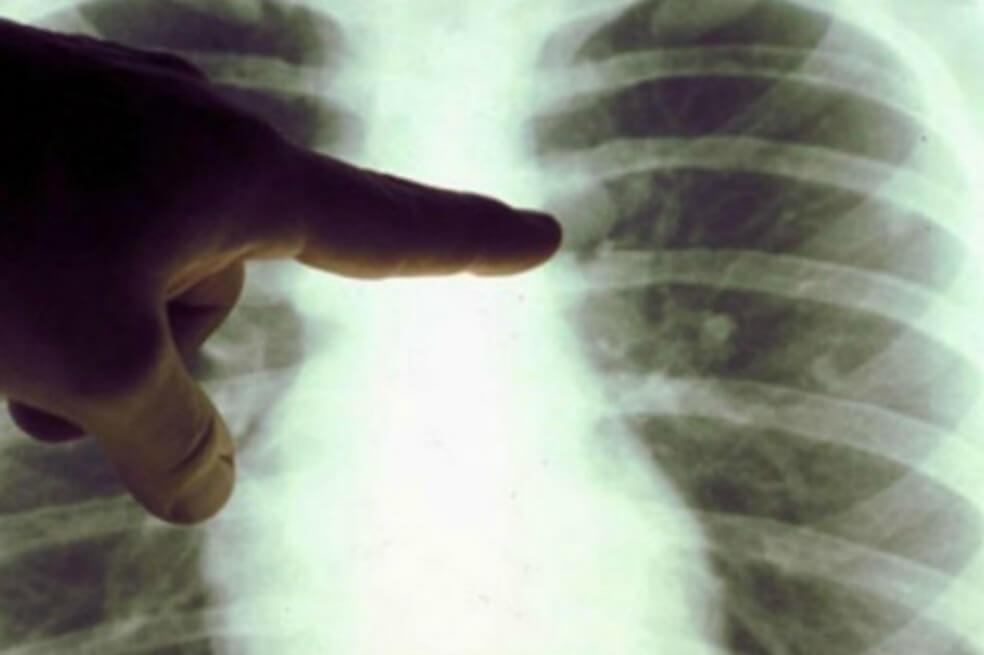 Algoritmo diseñado por Google detecta cáncer de pulmón con más eficiencia que los radiólogos