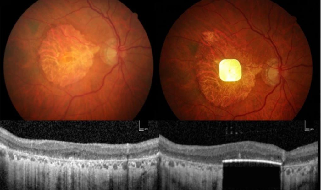 Un pequeño microimplante de retina da esperanza a personas que han perdido la vista