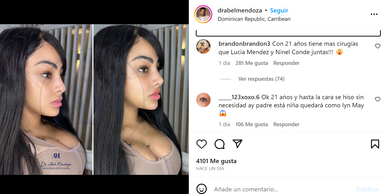 Yailin, ex de Anuel AA, se operó el rostro: así quedó tras su cambio extremo