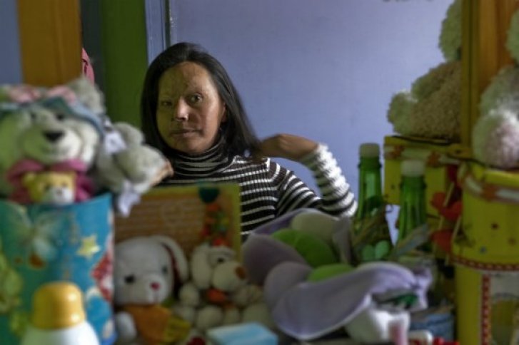 María Cuervo, una víctimas más de los ataques con ácido.