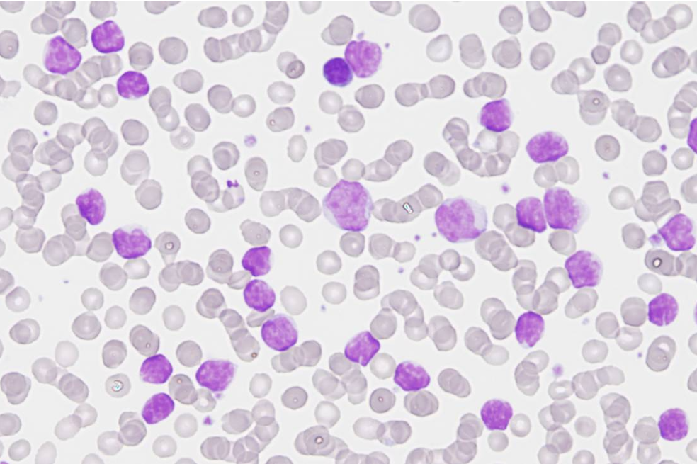 Por primera vez detallan cambios genéticos generados por leucemia linfática crónica