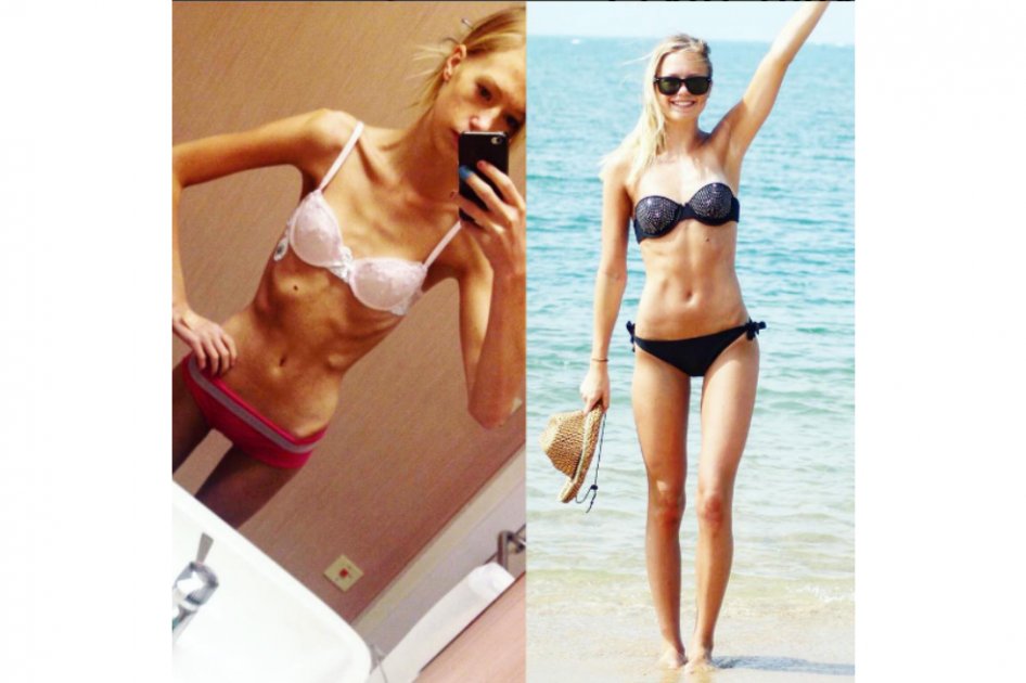 Impactantes imágenes de joven que superó la anorexia y se transformó en maestra de fitness