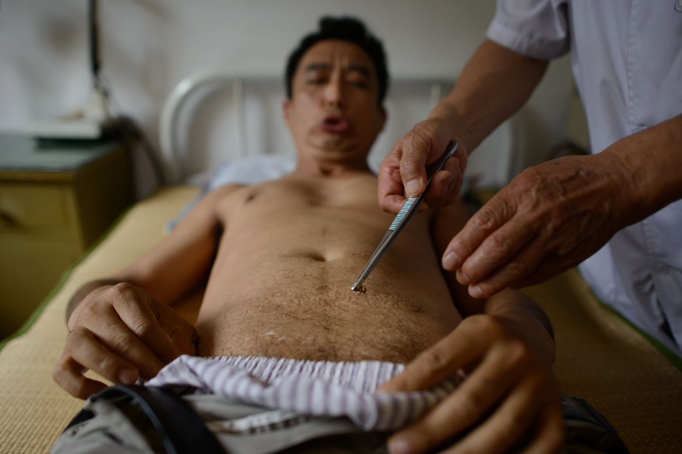 La terapia con picaduras de abejas en China
