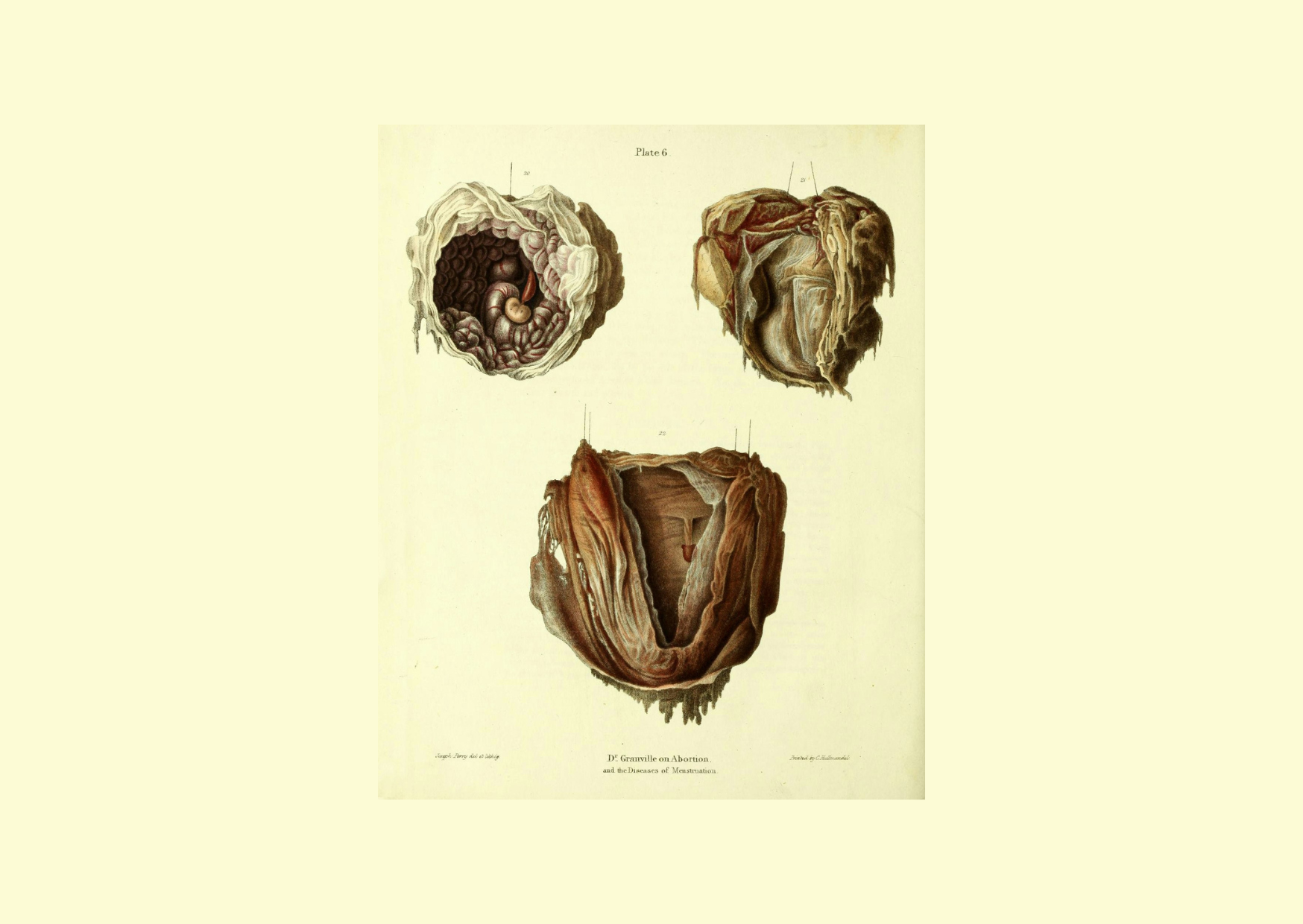 El artista Joseph Perry colaboró con Granville en el libro publicado en 1834 llamado: "Ilustraciones gráficas del aborto, con prolegómenos del desarrollo y metamorfosis del óvulo humano".