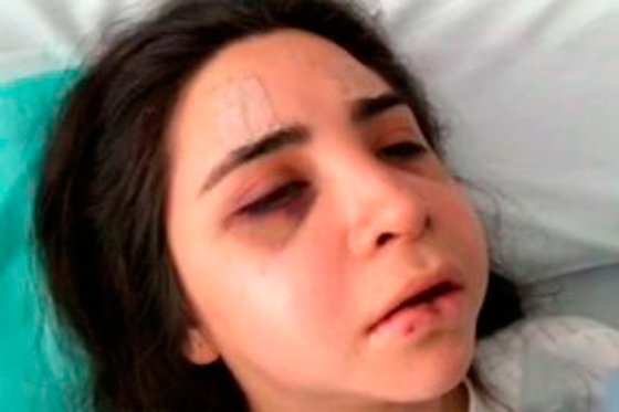 La joven María Alejandra Rodríguez Ramos, de 21 años, sufrió varias fracturas en el rostro tras la goliza que le propinó un agente de la Policía en el municipio de Santana (Boyacá).