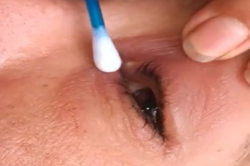 (VIDEO) Mujer terminó con un gusano en el ojo, ¿cómo se lo quitaron?