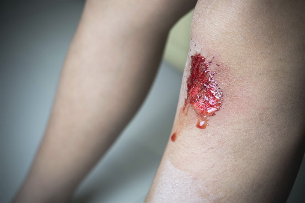 Las heridas se curan más lento si ocurren de noche