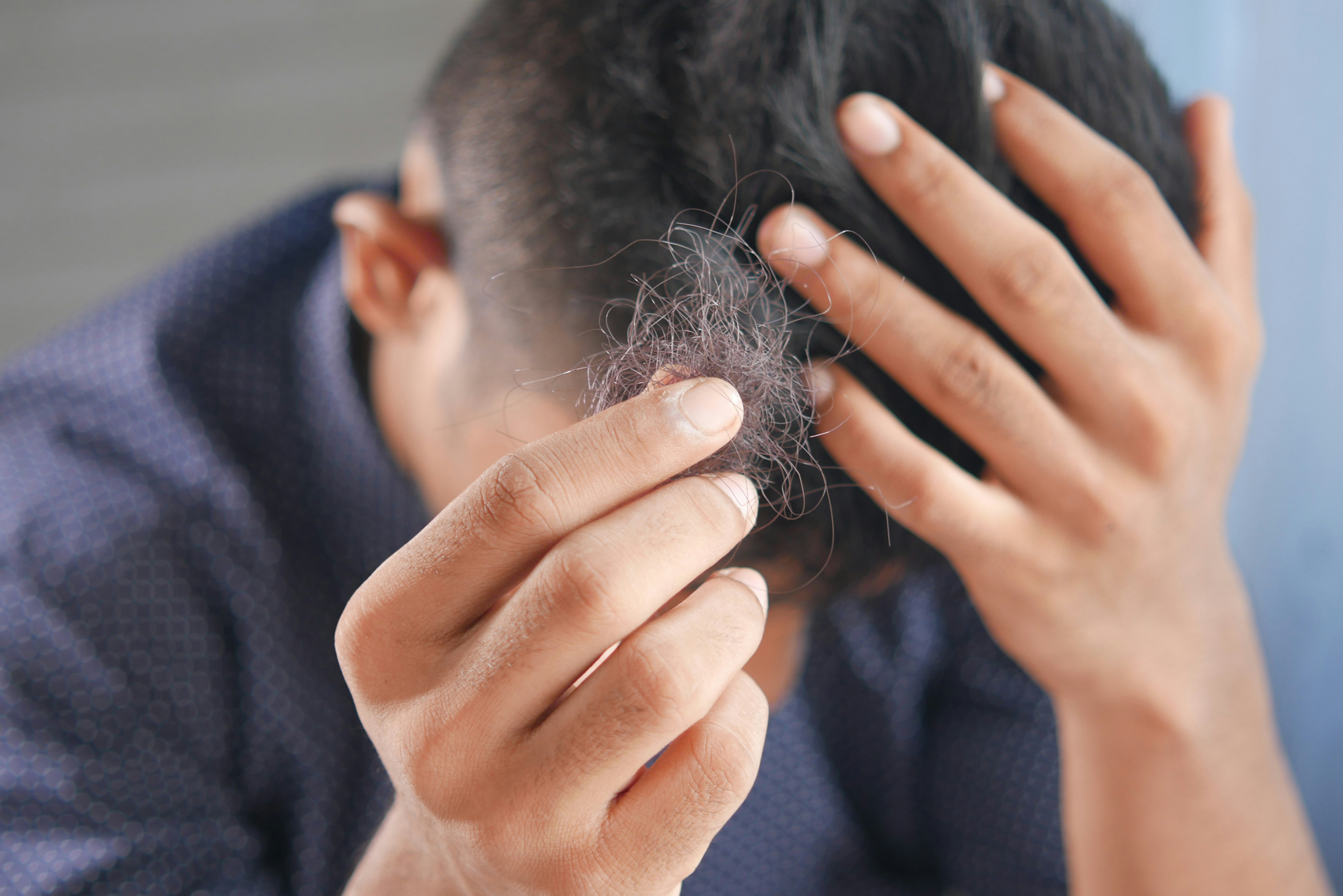 Alerta calvicie: ¿cómo evitar la caída del cabello antes de que sea tarde?