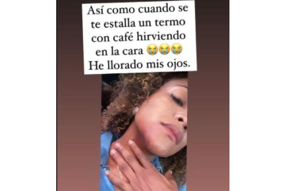 Mábel Lara se quemó con un termo de café hirviendo.