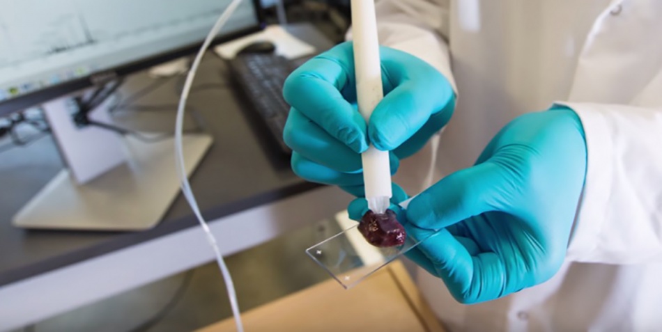 ¿Es posible detectar el cáncer por medio de un lápicero?