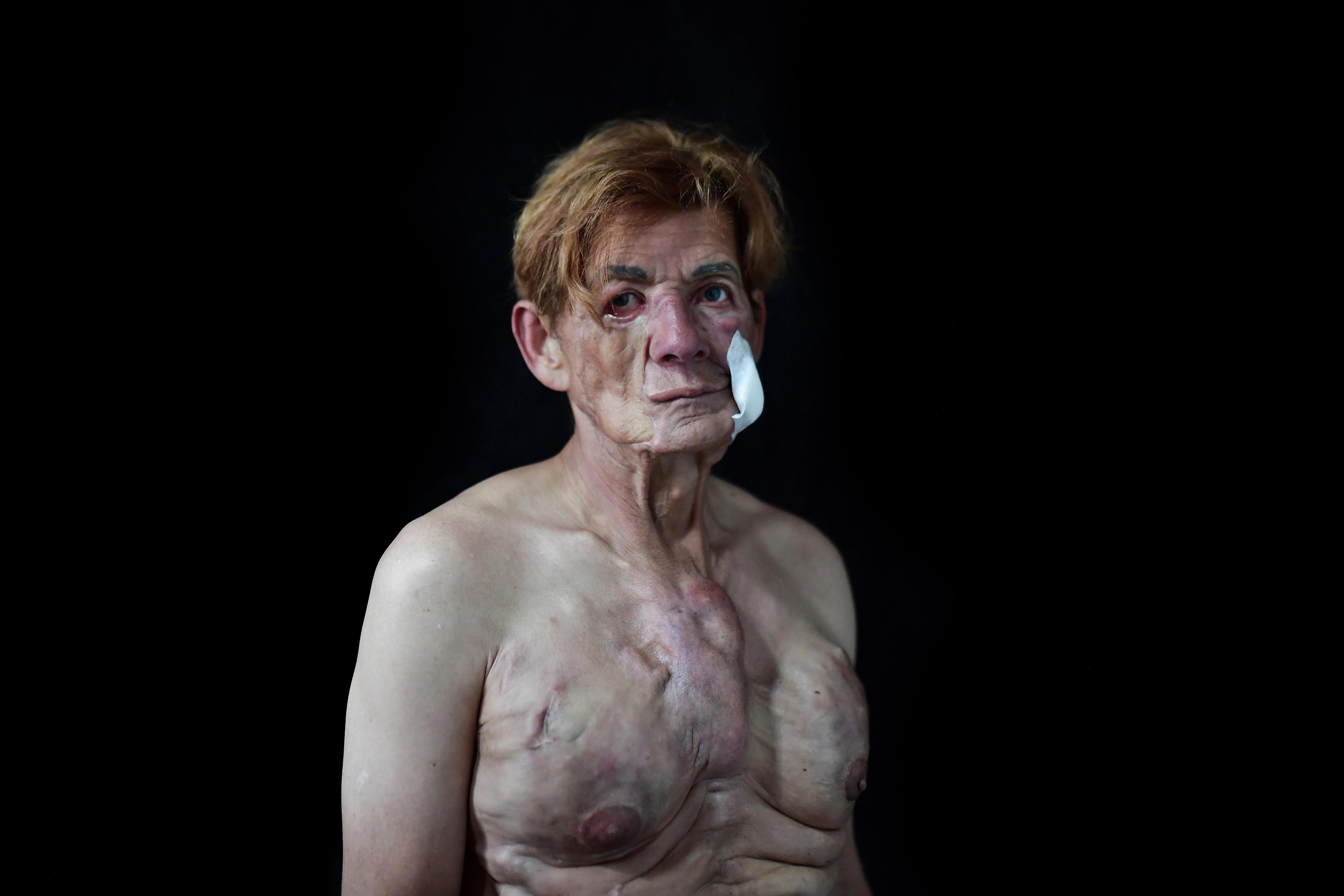 Yomaira: A sus 67 años, la noche del 31 de mayo de 2024 falleció Yomaira, a los 33 años se inyectó colágeno y aceite Johnson’s en su rostro, pecho, glúteos y piernas, reafirmando lo que desde siempre le fue negado, un tránsito seguro. Luchó media vida para que el sistema de salud le prestara una atención digna porque los biopolímeros invadieron su cuerpo. Este fotoreportaje es en homenaje a ella, quien fue la inspiración para contar estos relatos. Paz en su tumba.