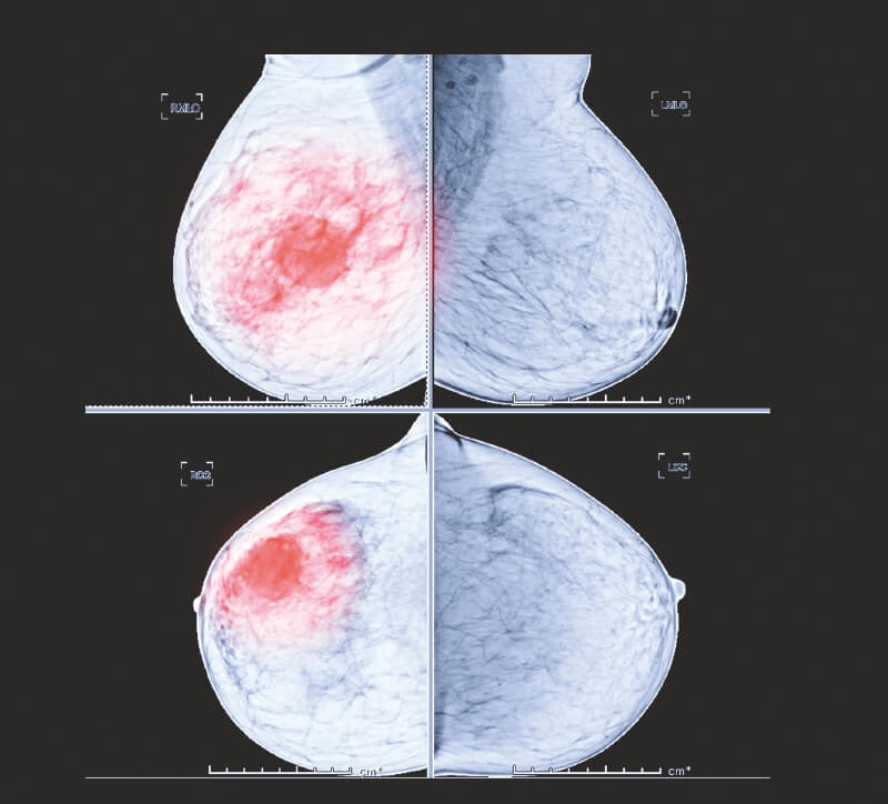 Así rastrean la herencia del cáncer de seno en las latinas