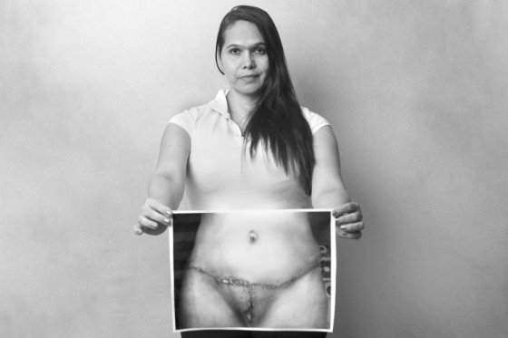 Cristina Trejos
44 años
Lugar: Medellín
Cirujano: Carlos Ramos Corena