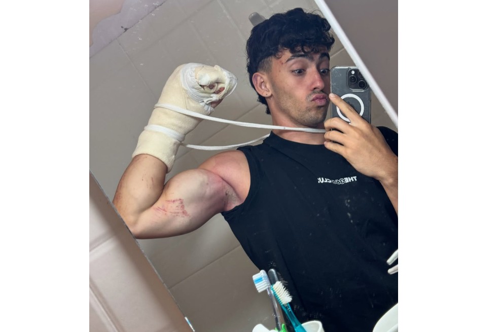 Influencer Gero Arias perdió dos dedos tras grave accidente “ojalá fuera mentira”
