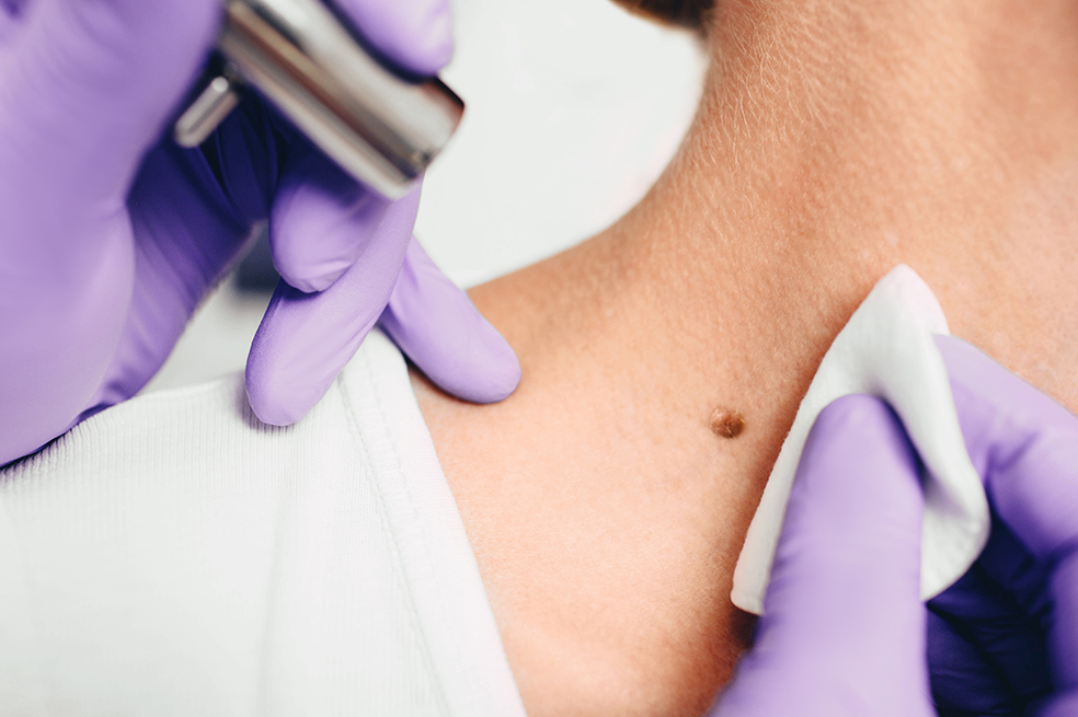 ¿Vio noticias sobre una nueva “vacuna” contra un cáncer? Acá le explicamos qué es y qué hace
