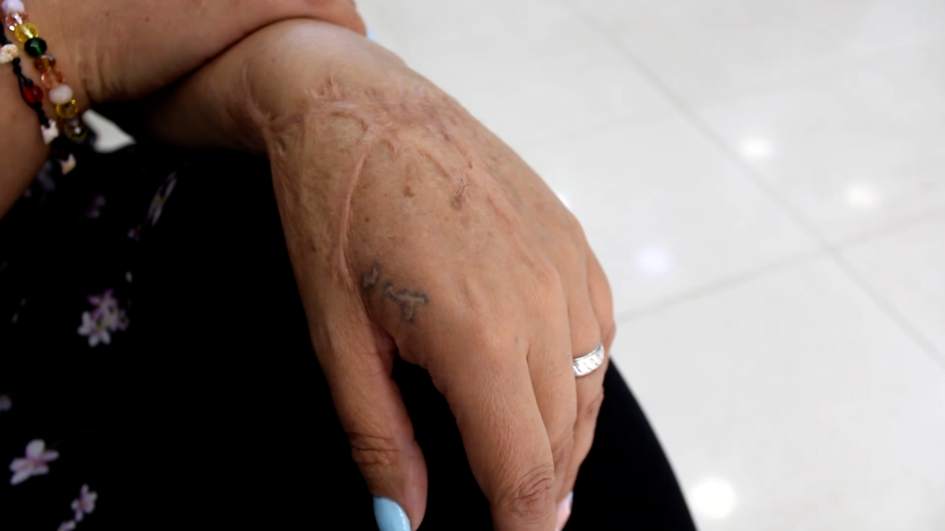 Nueva belleza: un reportaje sobre las agresiones con agentes químicos