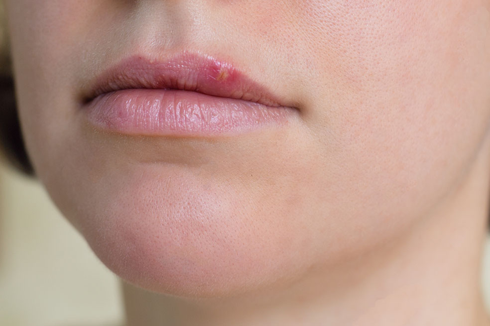 Tengo un herpes labial. ¿Qué hago?