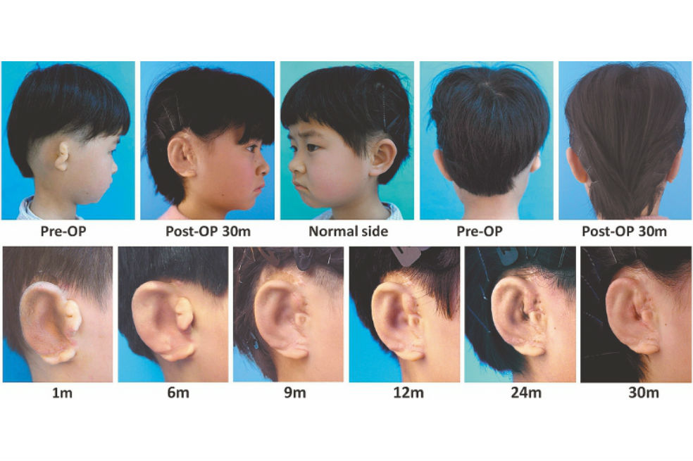 La progresión de un niño que recibió un nuevo oído como parte del estudio. /  EBioMedicine