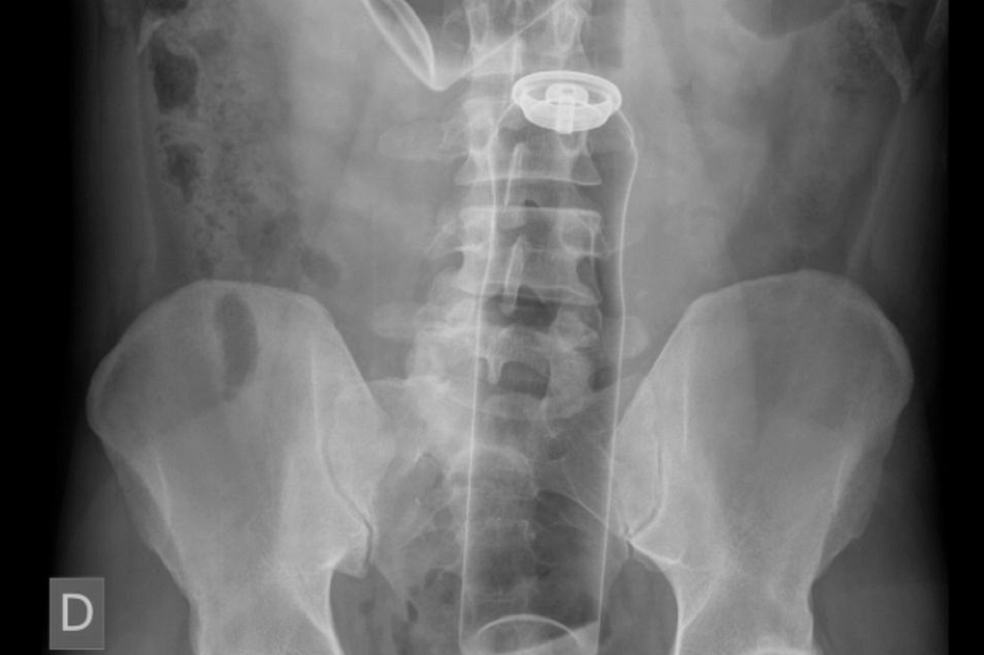 La medicina ha estigmatizado a personas que se introducen objetos extraños en el recto
