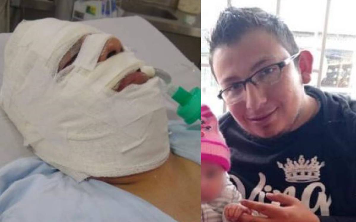 Con el 70 % de su rostro quemado, así permanece el taxista atacado con ácido