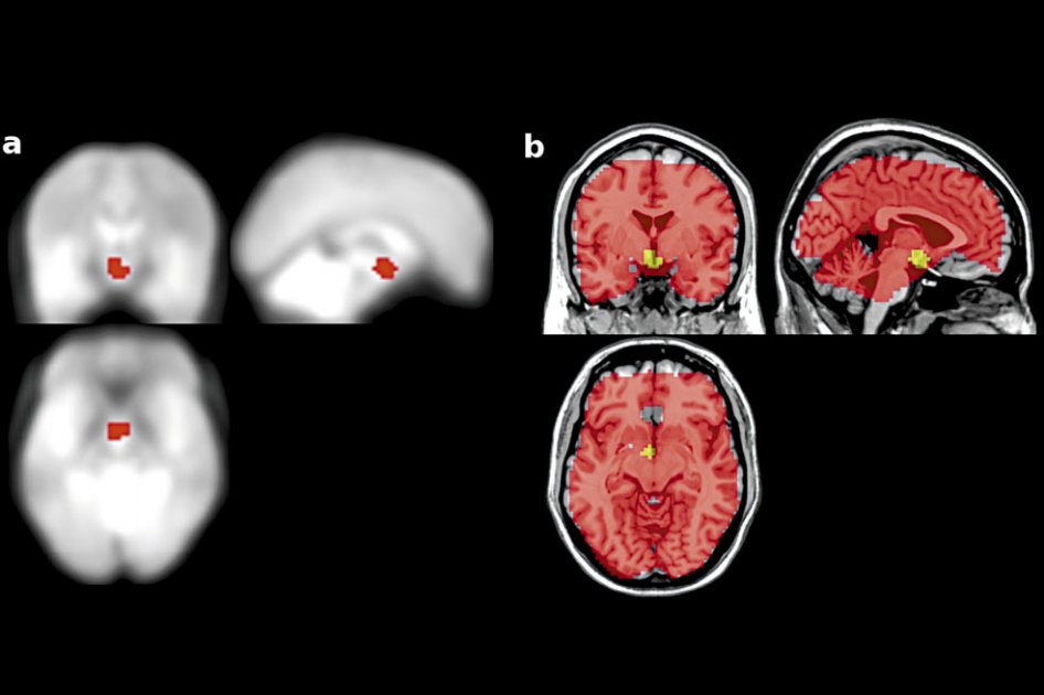 Imágenes de resonancia magnética le indican a la persona cómo se activa su cerebro. / Plos One