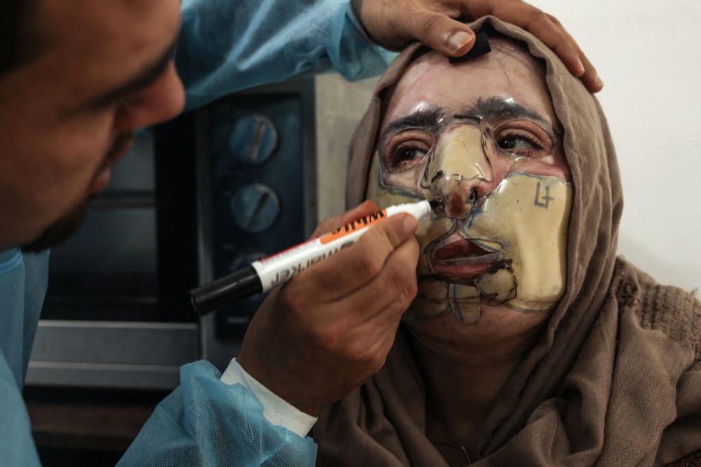 Izdihar al-Amawi sufrió graves quemaduras y el pasado 22 de febrero comenzó a usar una máscara diseñada por Médicos sin Fronteras.