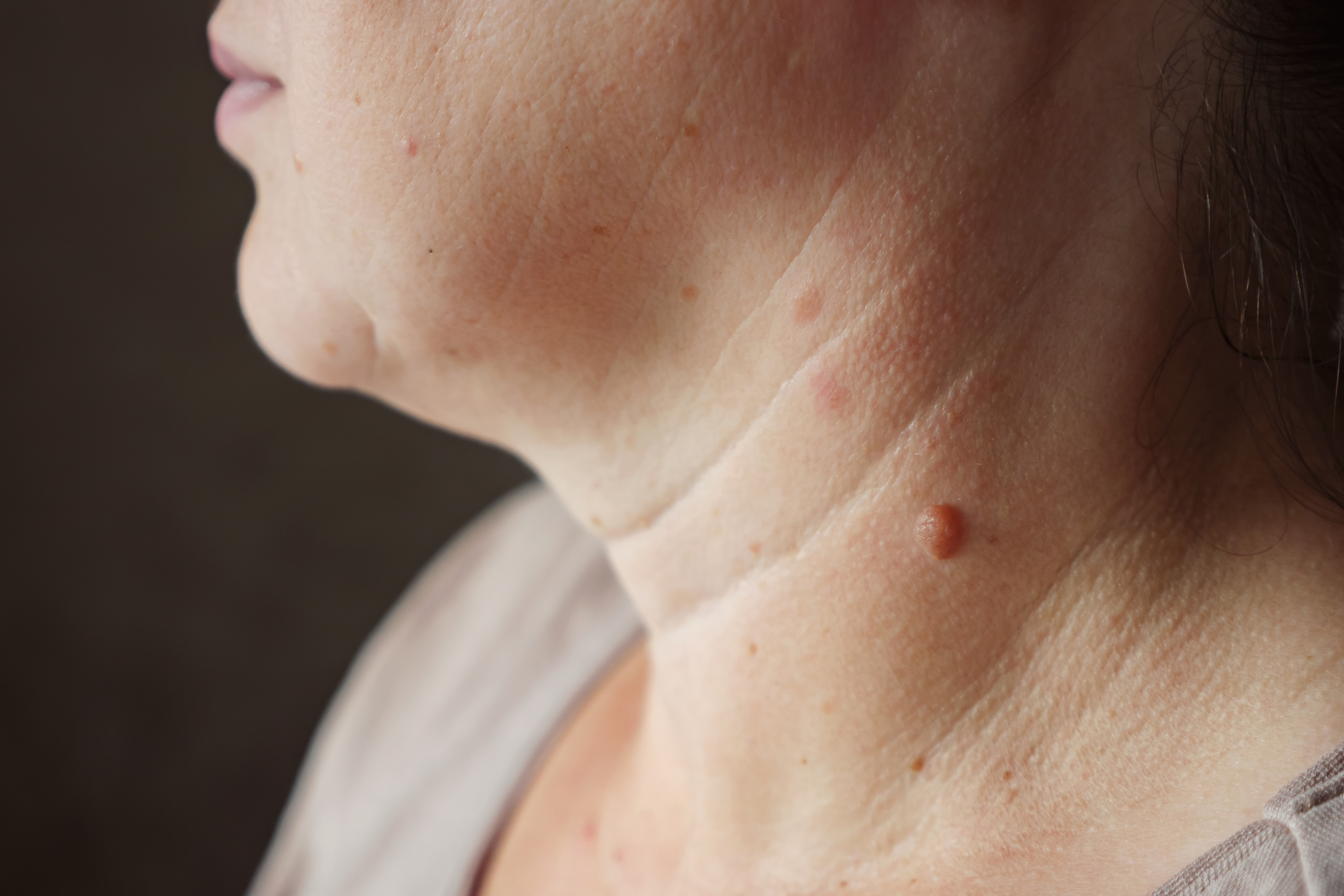 Las verrugas en el cuello pueden parecer inofensivas, pero eliminarlas sin control puede traer sorpresas desagradables.