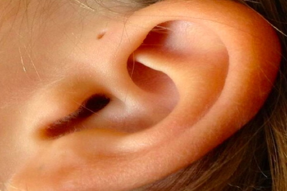 ¿Por qué unas personas tienen un hoyuelo en la parte superior de la oreja?