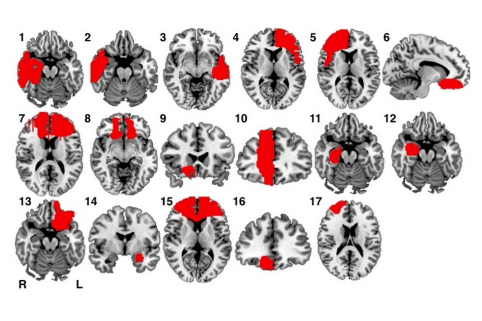 La relación entre las lesiones cerebrales y los crímenes