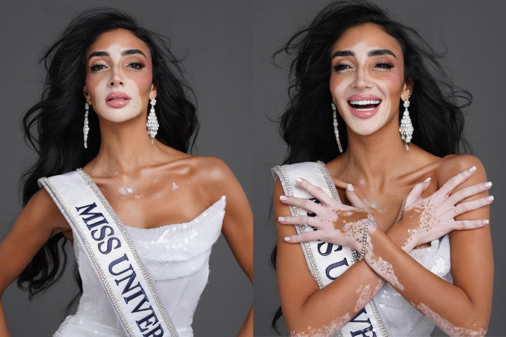 La inspiradora historia de la primera modelo con vitíligo en Miss Universe 2024