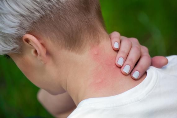 ¿Cómo evitar que te piquen los mosquitos durante el verano? Es muy fácil