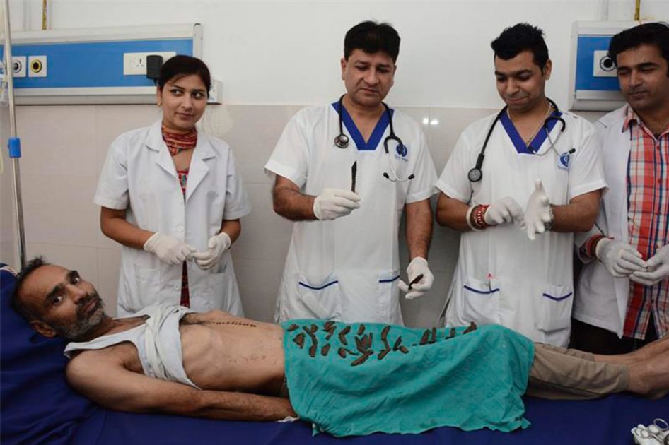 Extraen 40 cuchillos del estómago e intestino de un paciente