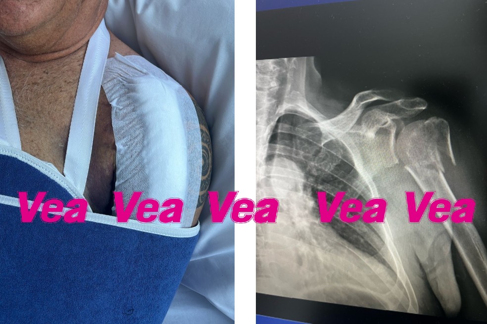 El presentador de ‘Sábados Felicitos’ fue sometido a una cirugía, luego de sufrir un accidente que le dejó tres fracturas.