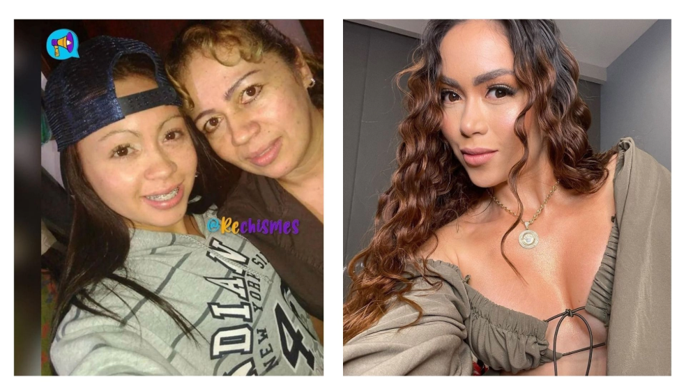Epa Colombia antes y después de sus cirugías.