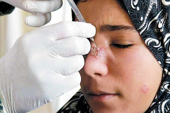 Decretan emergencia en Uruguay por casos de Leishmaniasis