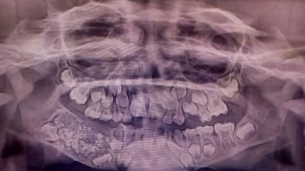 Extraen 526 dientes de la boca a un niño de siete años y otras noticias curiosas de la semana