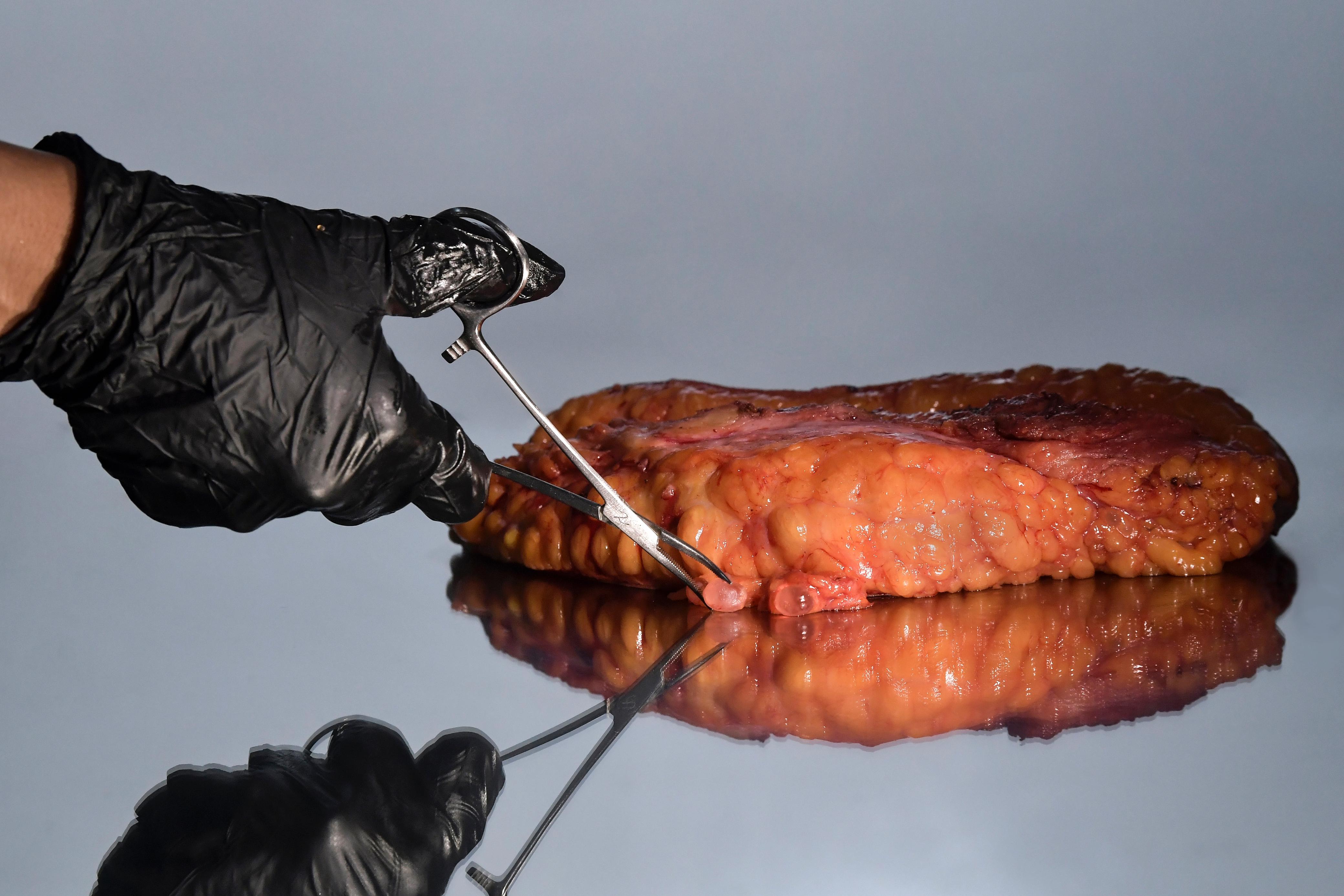 Los biopolímeros se adhieren a los músculos del cuerpo de manera inmediata. Al realizarse el retiro del producto las esferas suelen explotarse y exponer un líquido espeso similar al aceite.