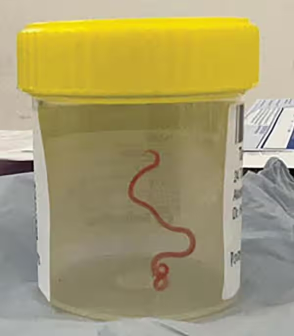 Por primera vez encuentran un gusano vivo en el cerebro de un ser humano