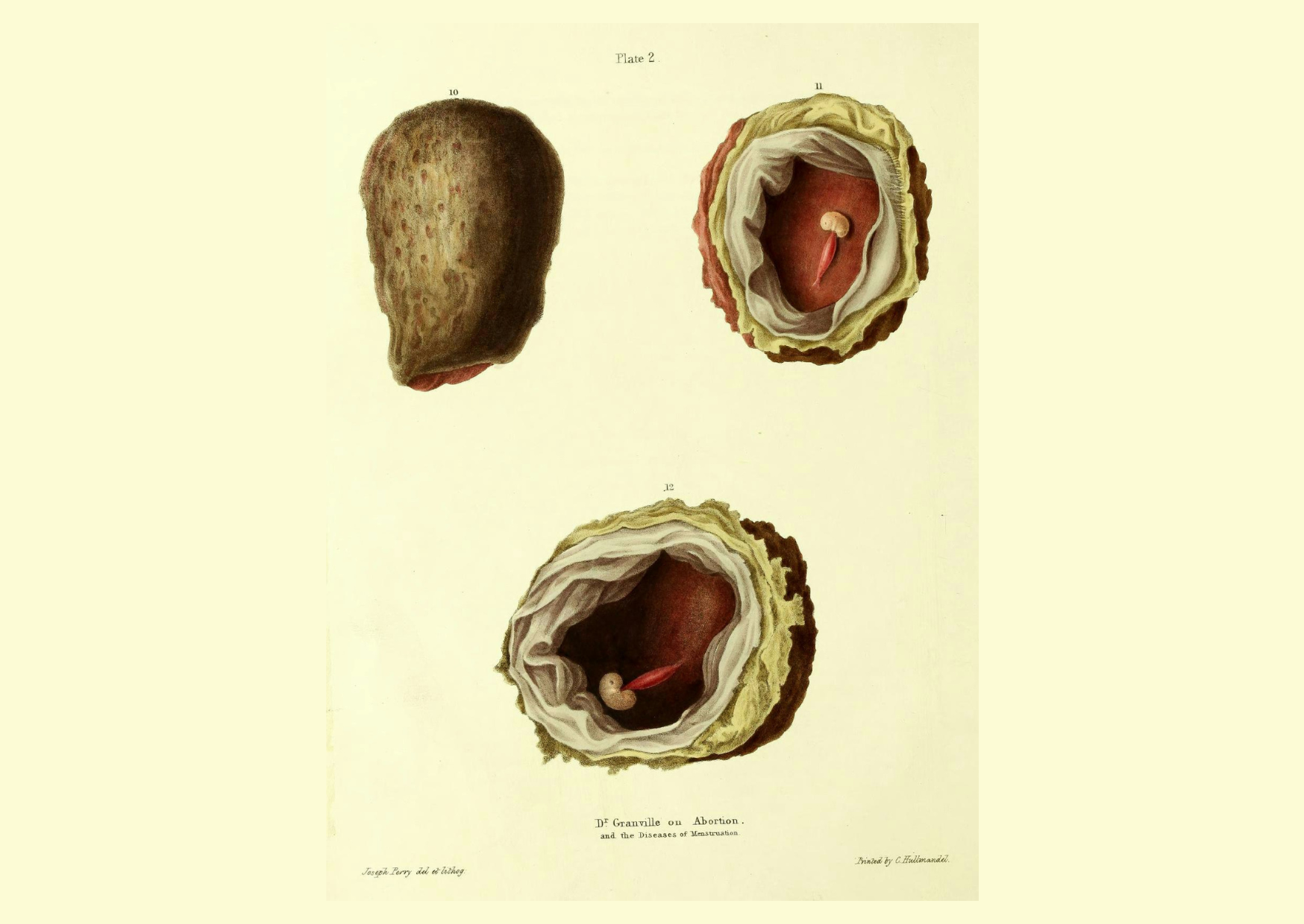 El artista Joseph Perry colaboró con Granville en el libro publicado en 1834 llamado: "Ilustraciones gráficas del aborto, con prolegómenos del desarrollo y metamorfosis del óvulo humano".