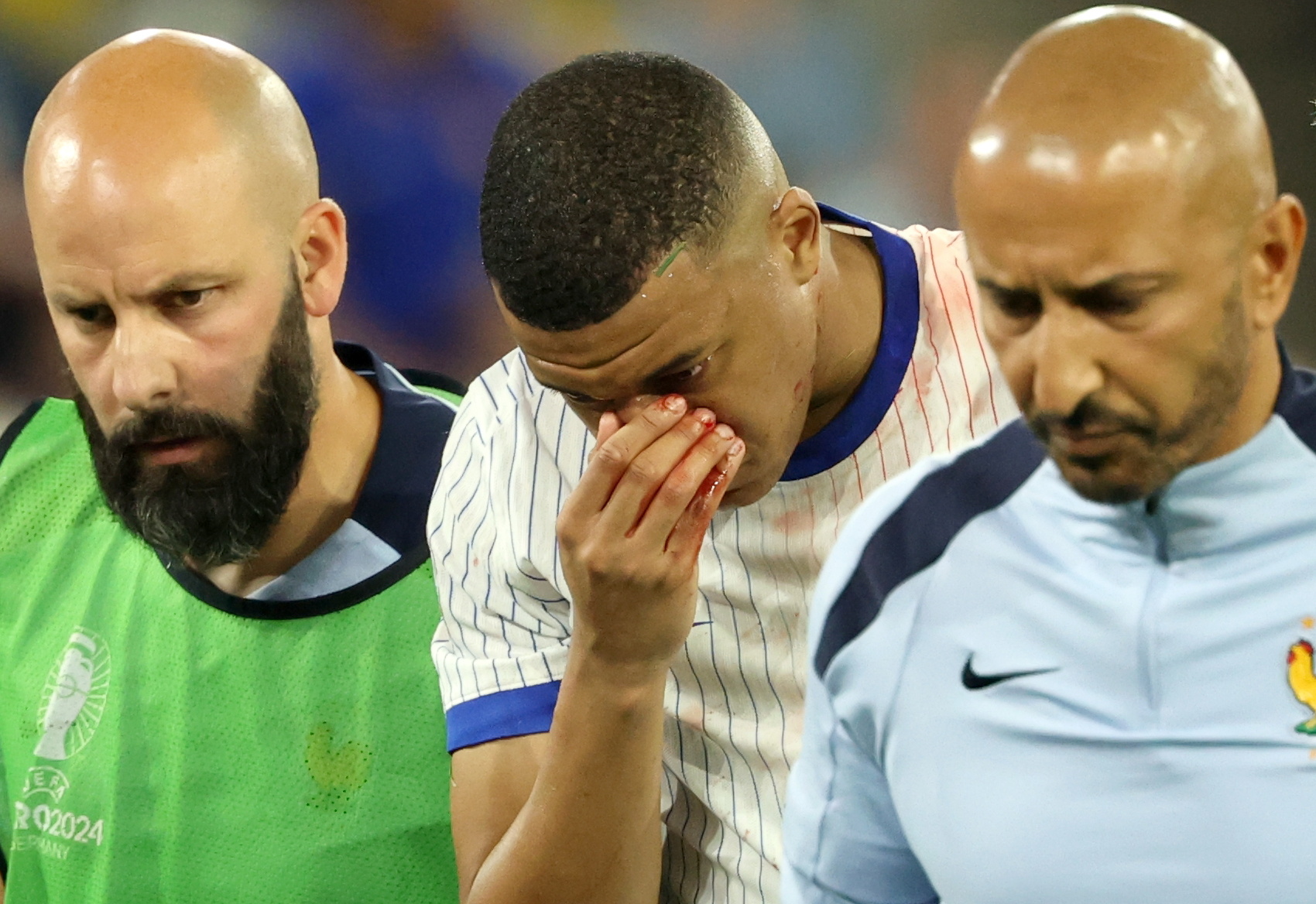 Mbappé sufrió una  fractura de nariz, pero no se someterá a una cirugía