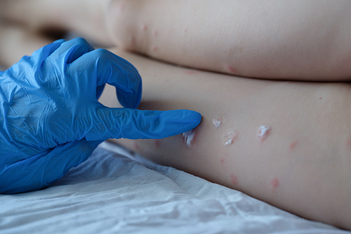 Viruela del mono en Colombia: ¿qué es, síntomas y cómo se contagia?