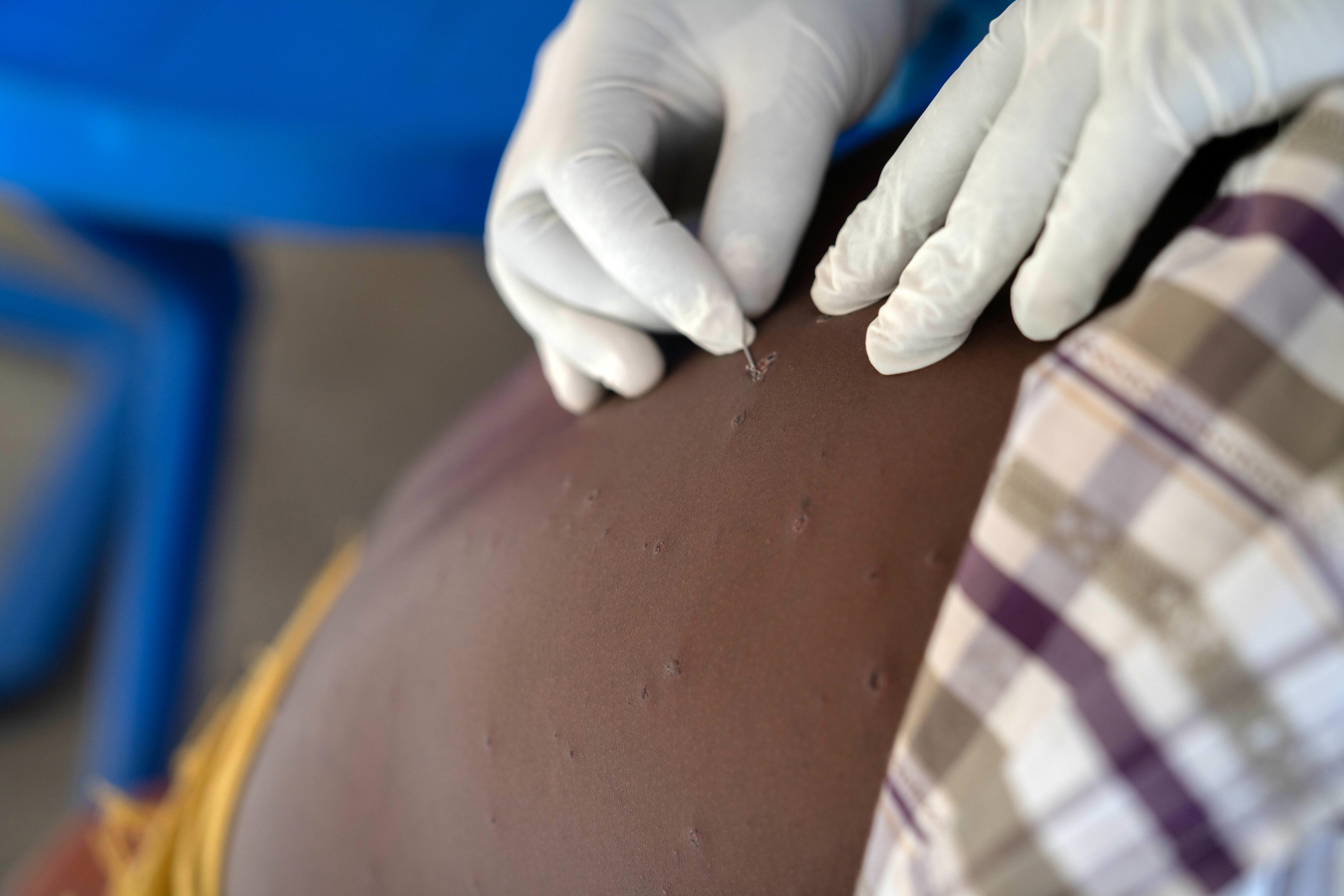 Munigi (Congo, The Democratic Republic Of The), 19/08/2024.- A young patient receives treatment for mpox at the Munigi Health Centre in Munigi, Democratic Republic of the Congo, 19 August 2024. The World Health Organization (WHO) declared a global health emergency in response to the latest outbreak of mpox (monkeypox) in the Democratic Republic of Congo and other countries in Africa. Mpox, whose symptoms include fever, rash, lesions on all parts of the body, severe headaches, and fatigue, could lead to sepsis in severe cases, a life-threatening response to infection. Additionally, some children develop respiratory problems, have difficulty swallowing, and are at higher risk for secondary bacterial infections. EFE/EPA/MOISE KASEREKA