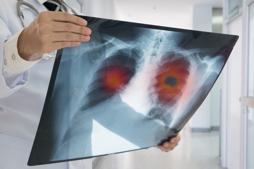 Silicosis: qué es, cuáles son los síntomas y cómo se trata esta enfermedad