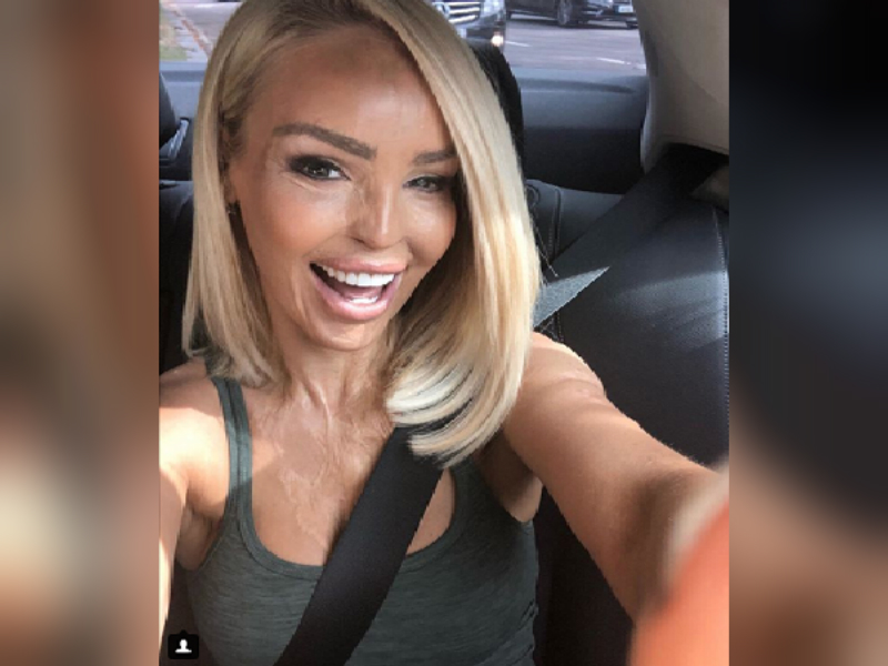 Katie Piper, la modelo que fue atacada con ácido sulfúrico