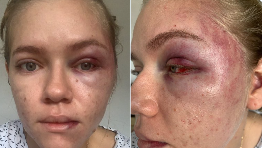 “Me ahorcó cuatro veces”: ingeniera denuncia ataque violento de concejal de Ocaña
