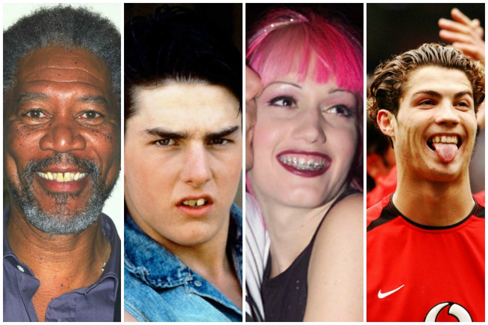 Famosos antes y después de tratamientos dentales